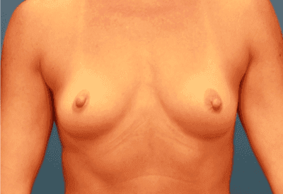 Breast case #5182 before