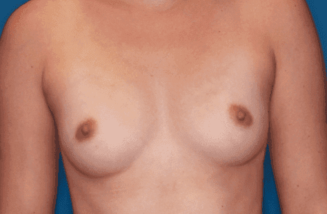 Breast case #5071 before