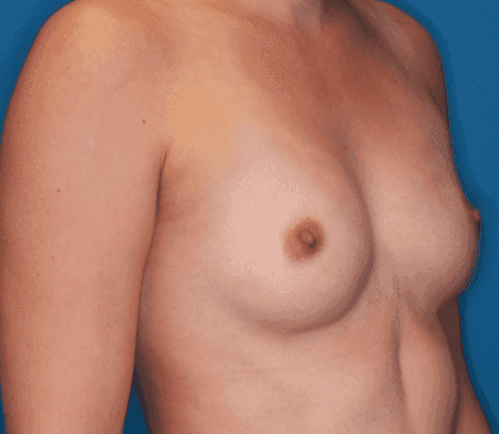 Breast case #5071 before, image 2