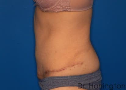 Body case #133 after, image 2