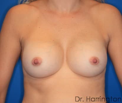 Breast case #123 after