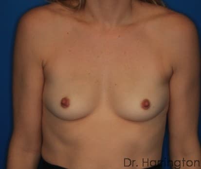 Breast case #123 before