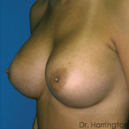 Breast case #66 after, image 2