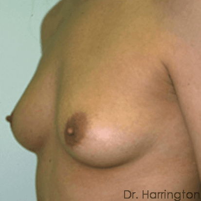 Breast case #66 before, image 2