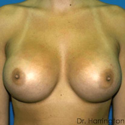 Breast case #66 after