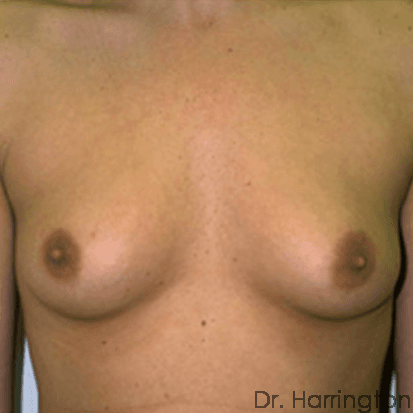 Breast case #66 before