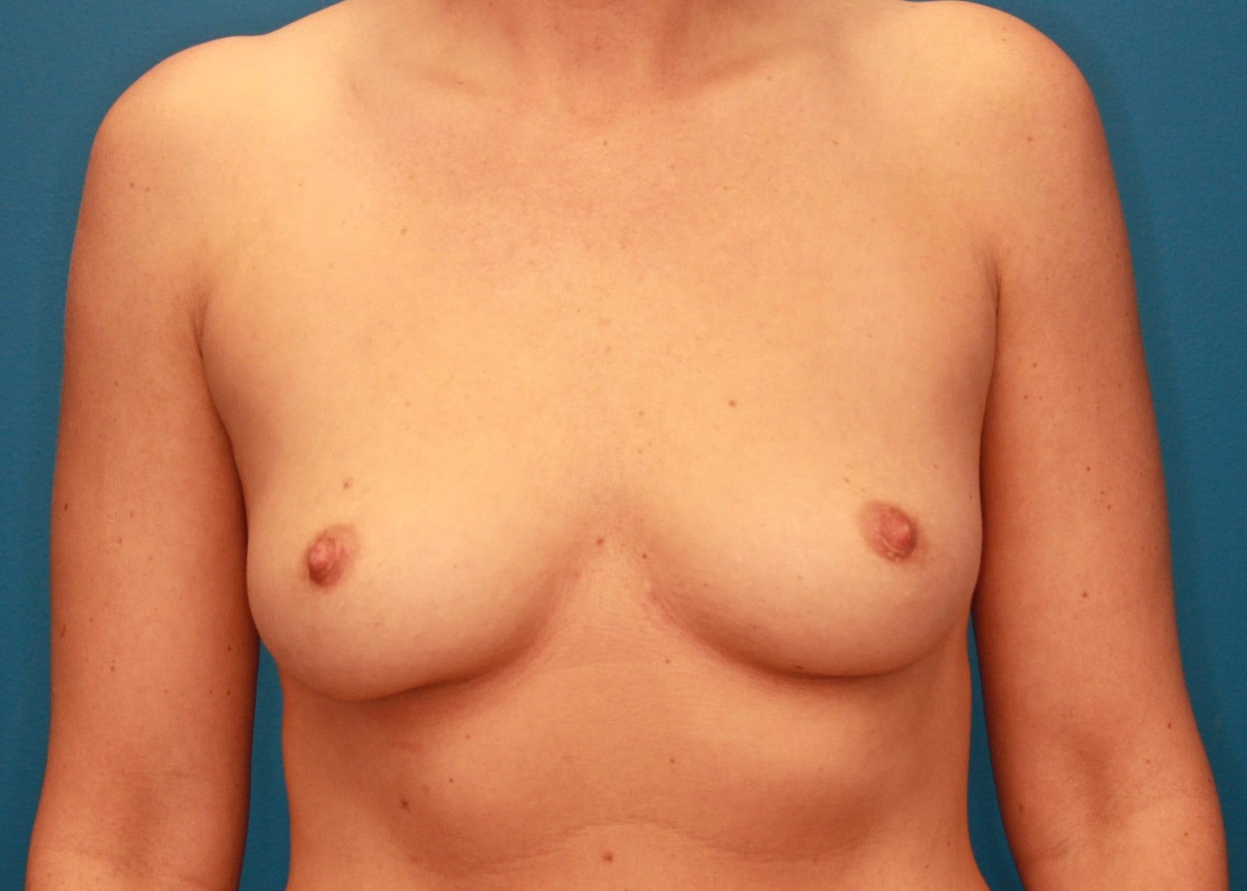 Breast case #163 before