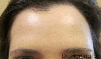 Face case #120 after