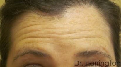 Face case #120 before