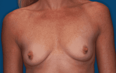 Breast case #5056 before