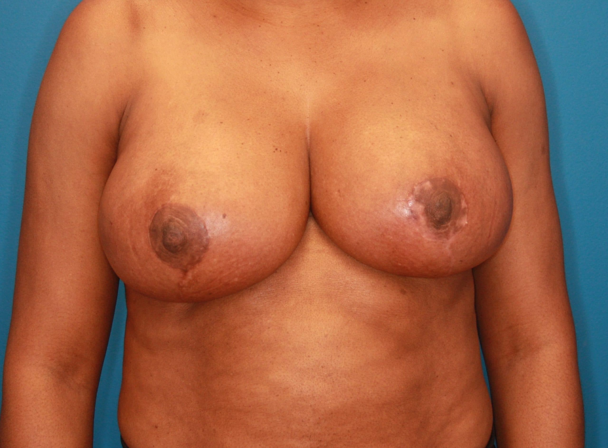 Breast case #143 after