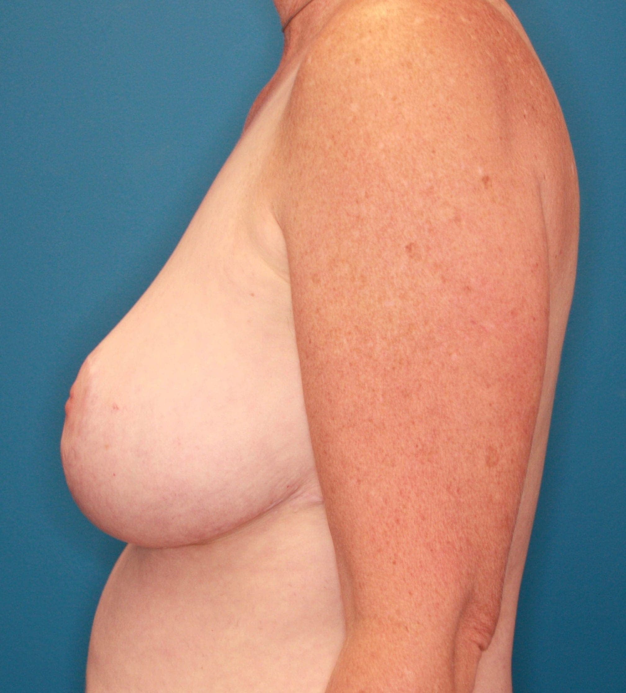 Breast case #168 after, image 3