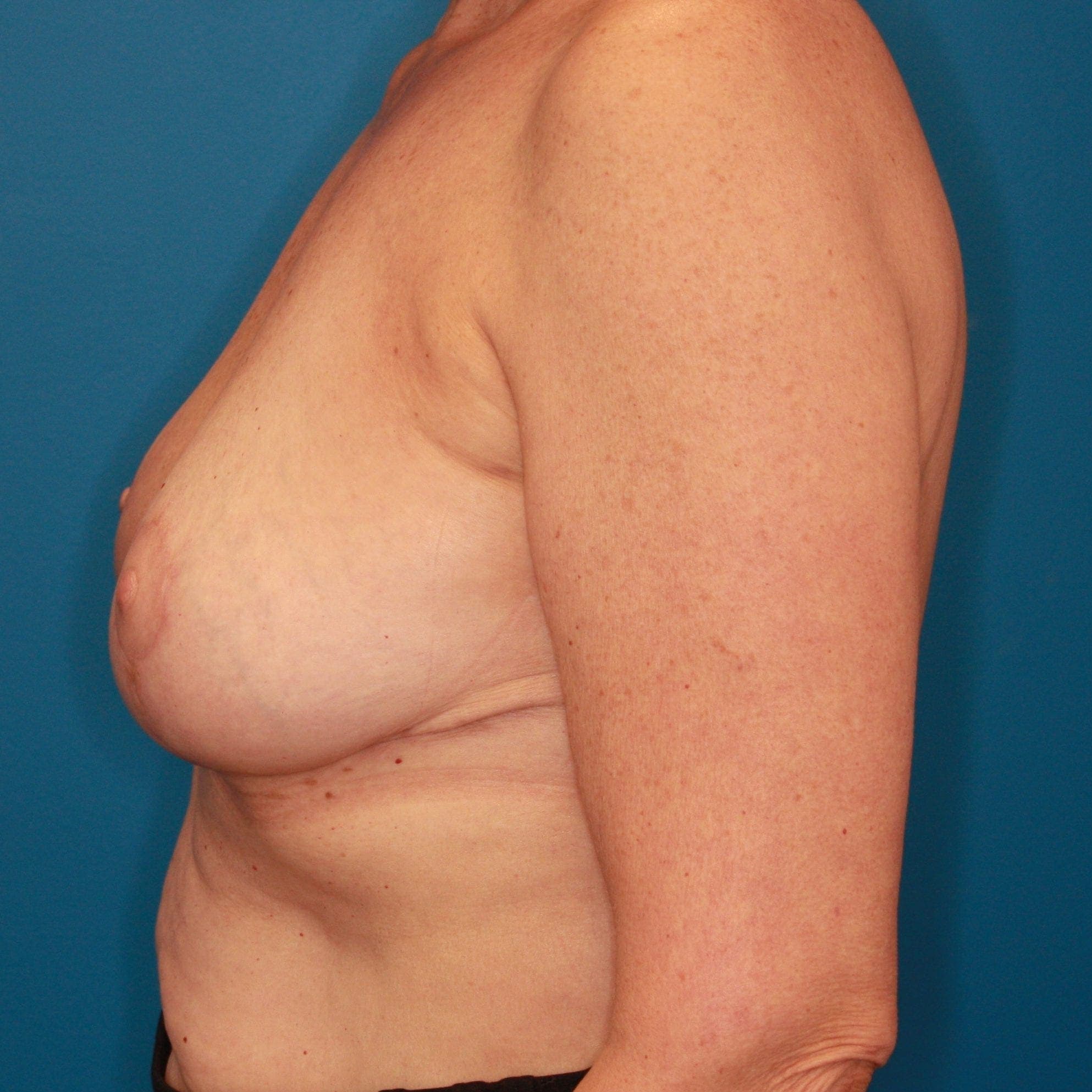 Breast case #142 after, image 3