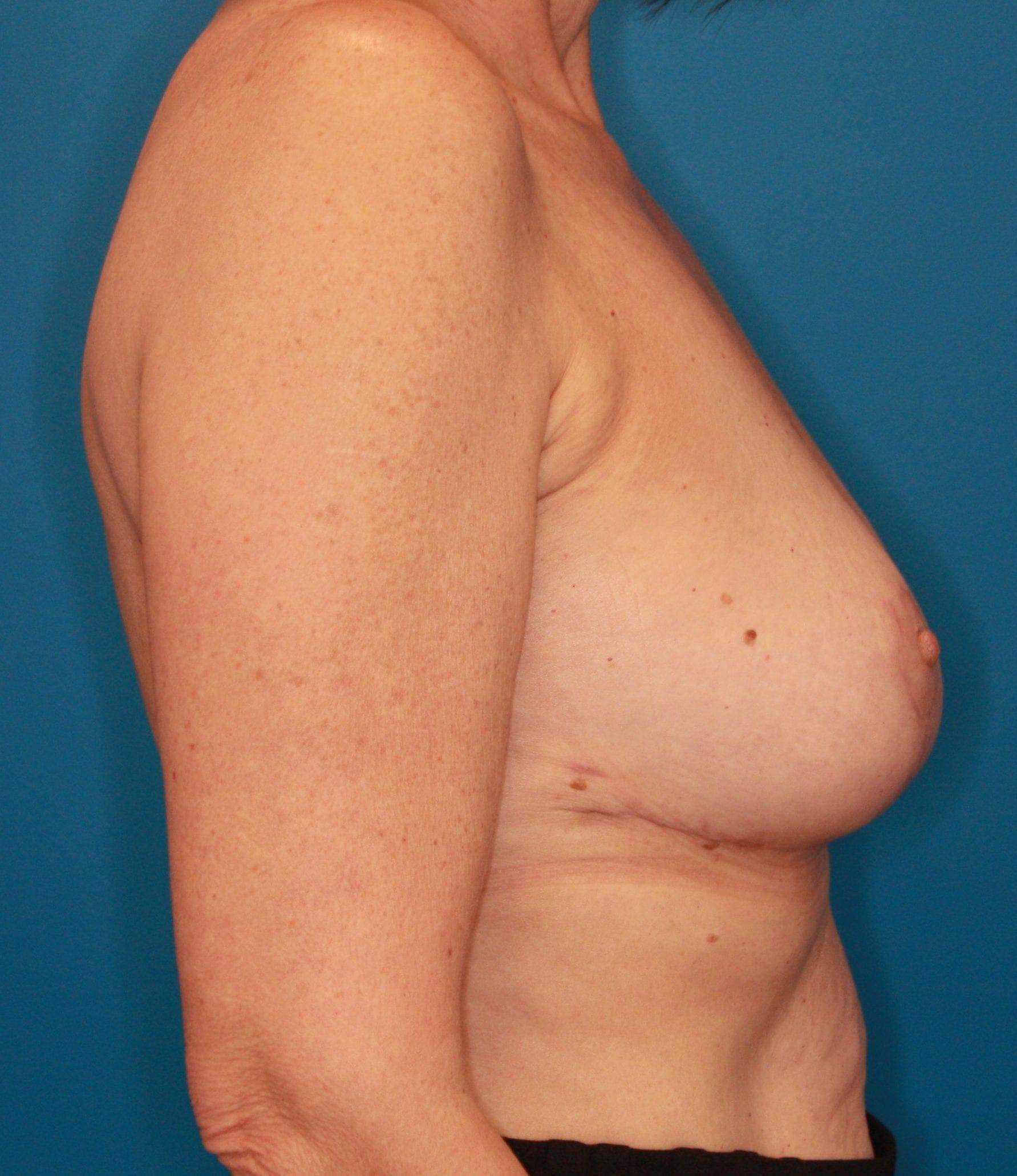 Breast case #142 after, image 5