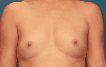 Breast case #5049 before, image 2