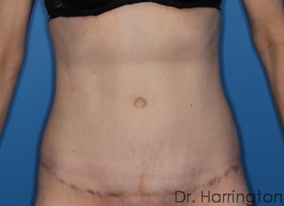 Body case #117 after