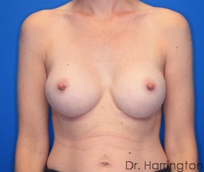 Breast case #134 after