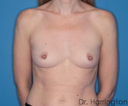 Breast case #134 before