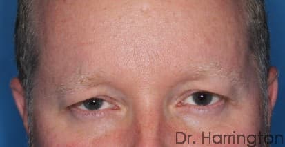 Face case #119 after