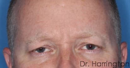 Face case #119 before