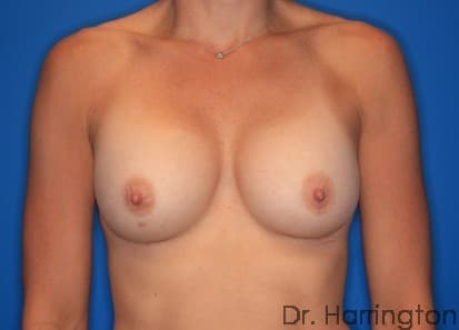 Breast case #127 after