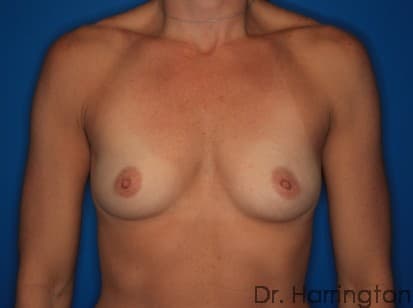 Breast case #127 before