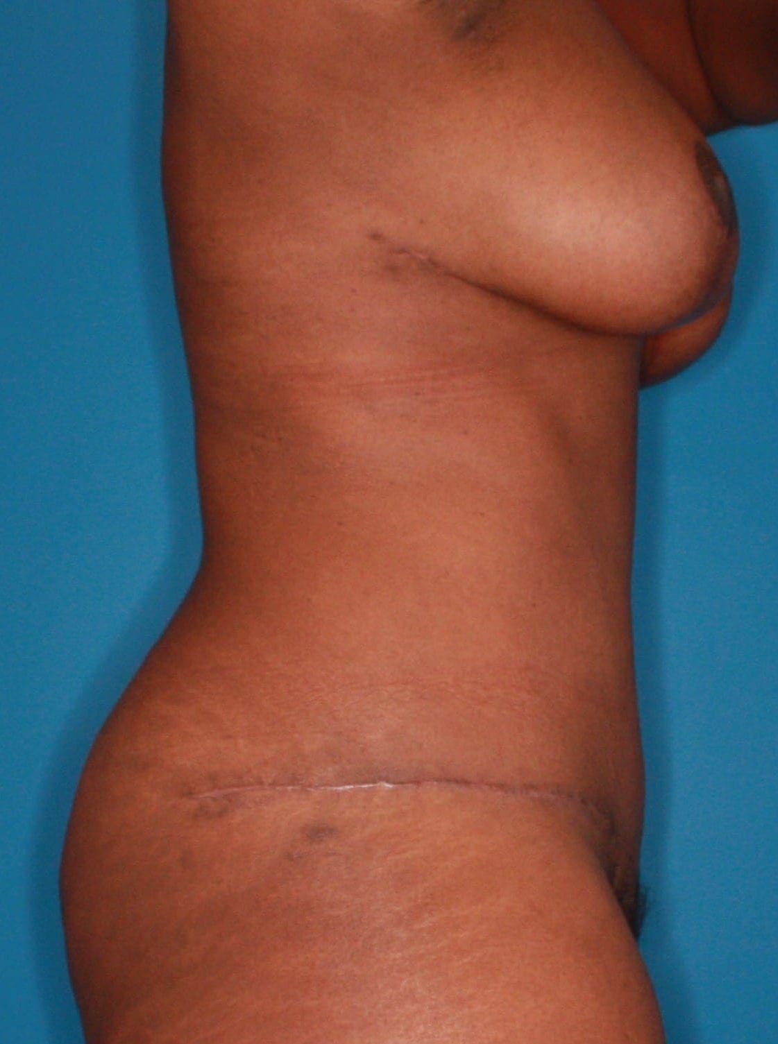 Breast case #165 after, image 5