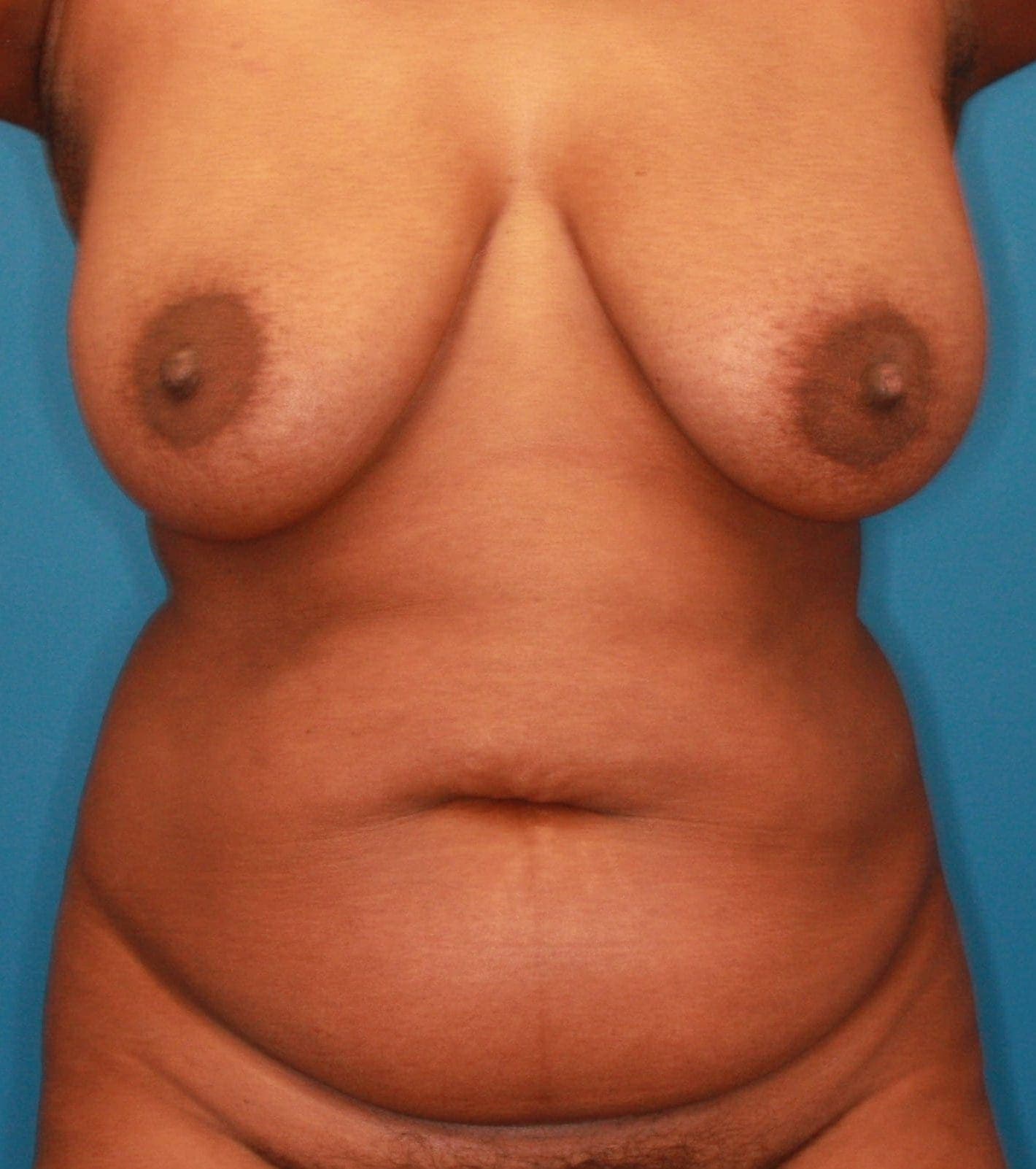 Breast case #165 before
