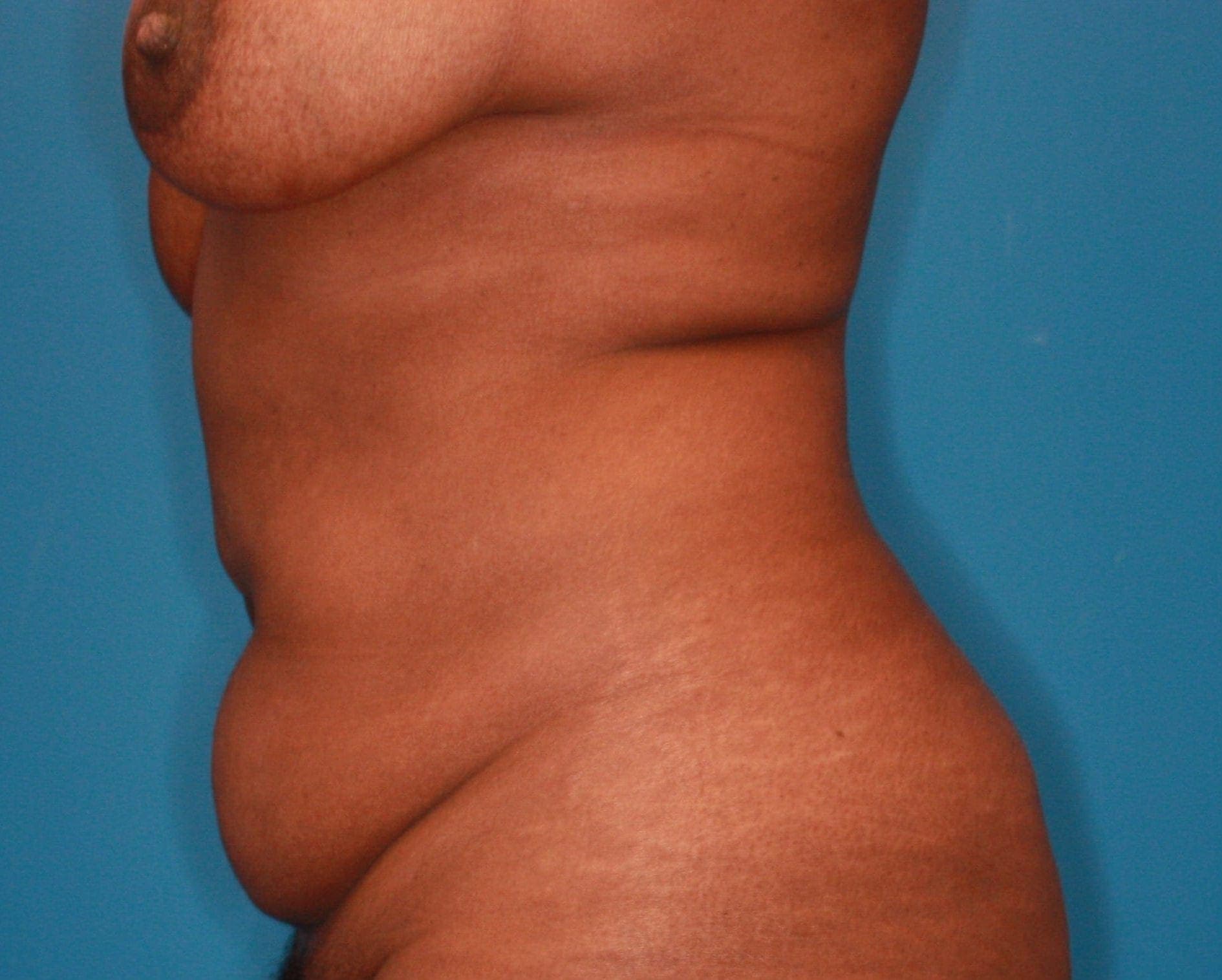 Breast case #165 before, image 2