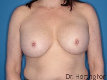 Breast case #106 before
