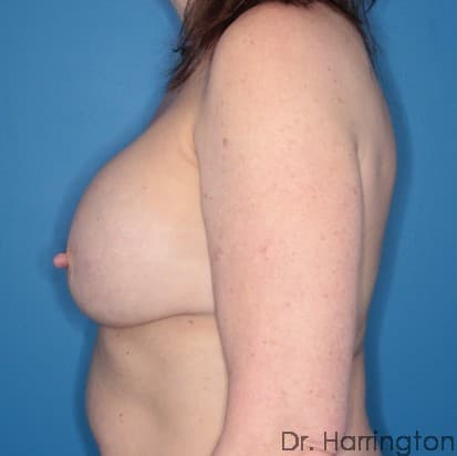 Breast case #106 before, image 2