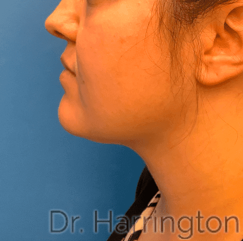 Face case #8016 after