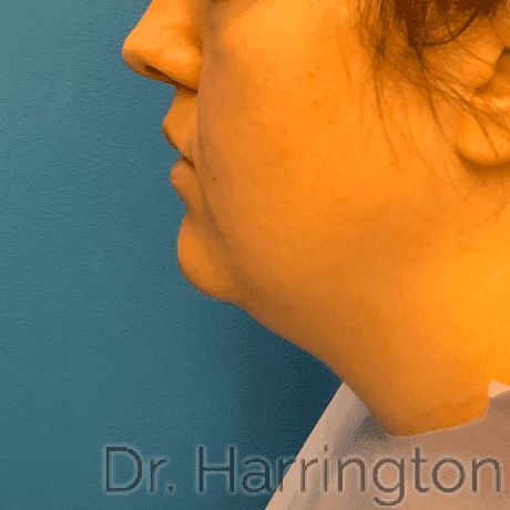 Face case #8016 before