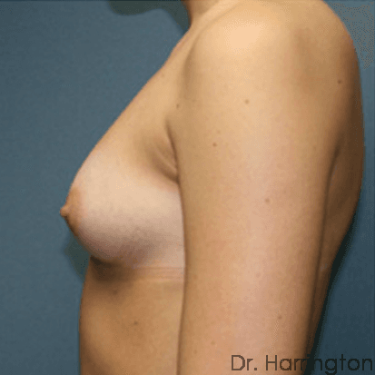 Breast case #69 before, image 2