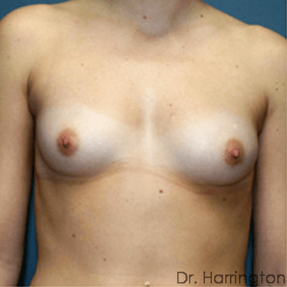 Breast case #69 before