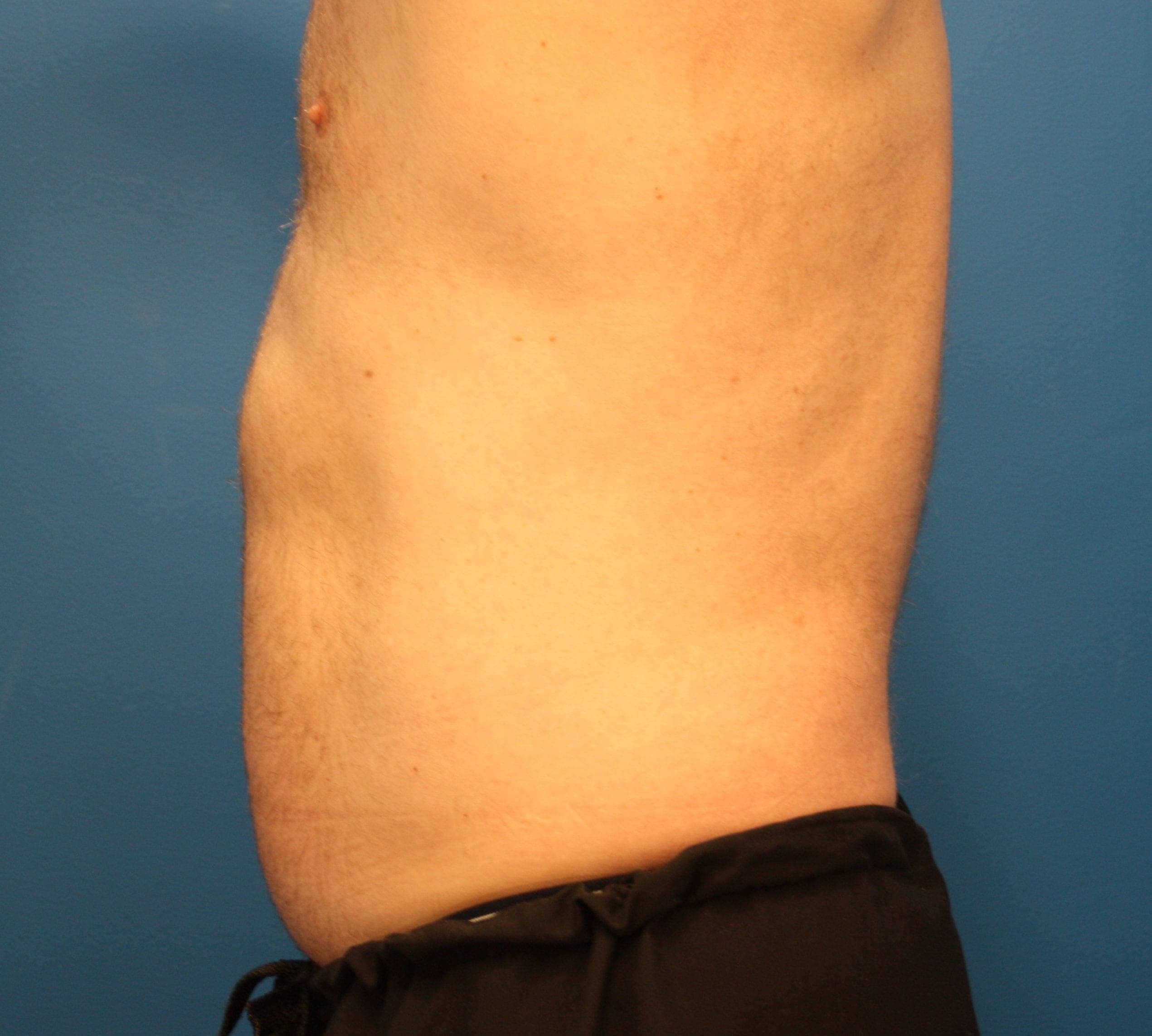 Body case #180 before, image 3