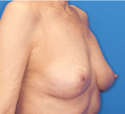 Breast case #5190 after, image 2