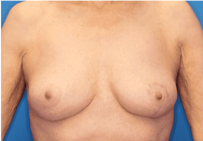 Breast case #5190 after