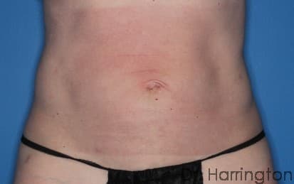 Body case #104 after