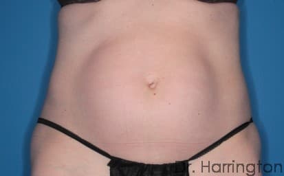 Body case #104 before