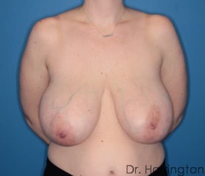 Breast case #108 before