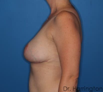 Breast case #108 after, image 2