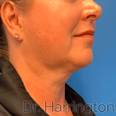 Face case #8011 after