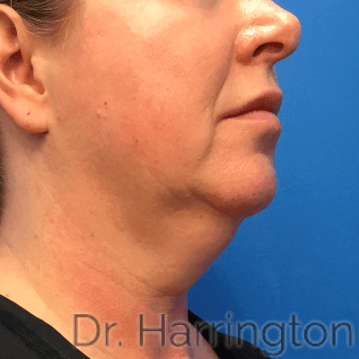 Face case #8011 before