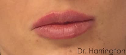 Face case #122 after