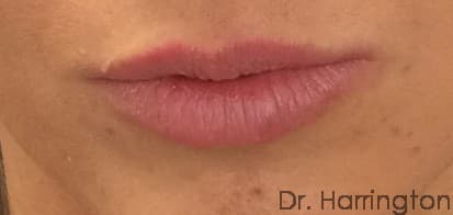 Face case #122 before