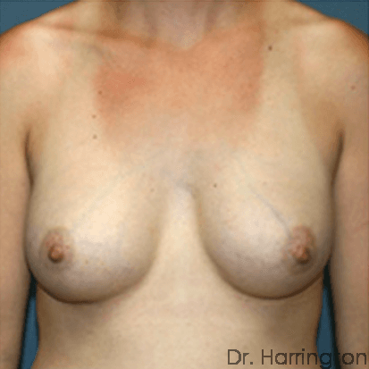 Breast case #70 after