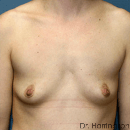 Breast case #70 before