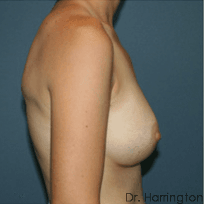 Breast case #70 after, image 2