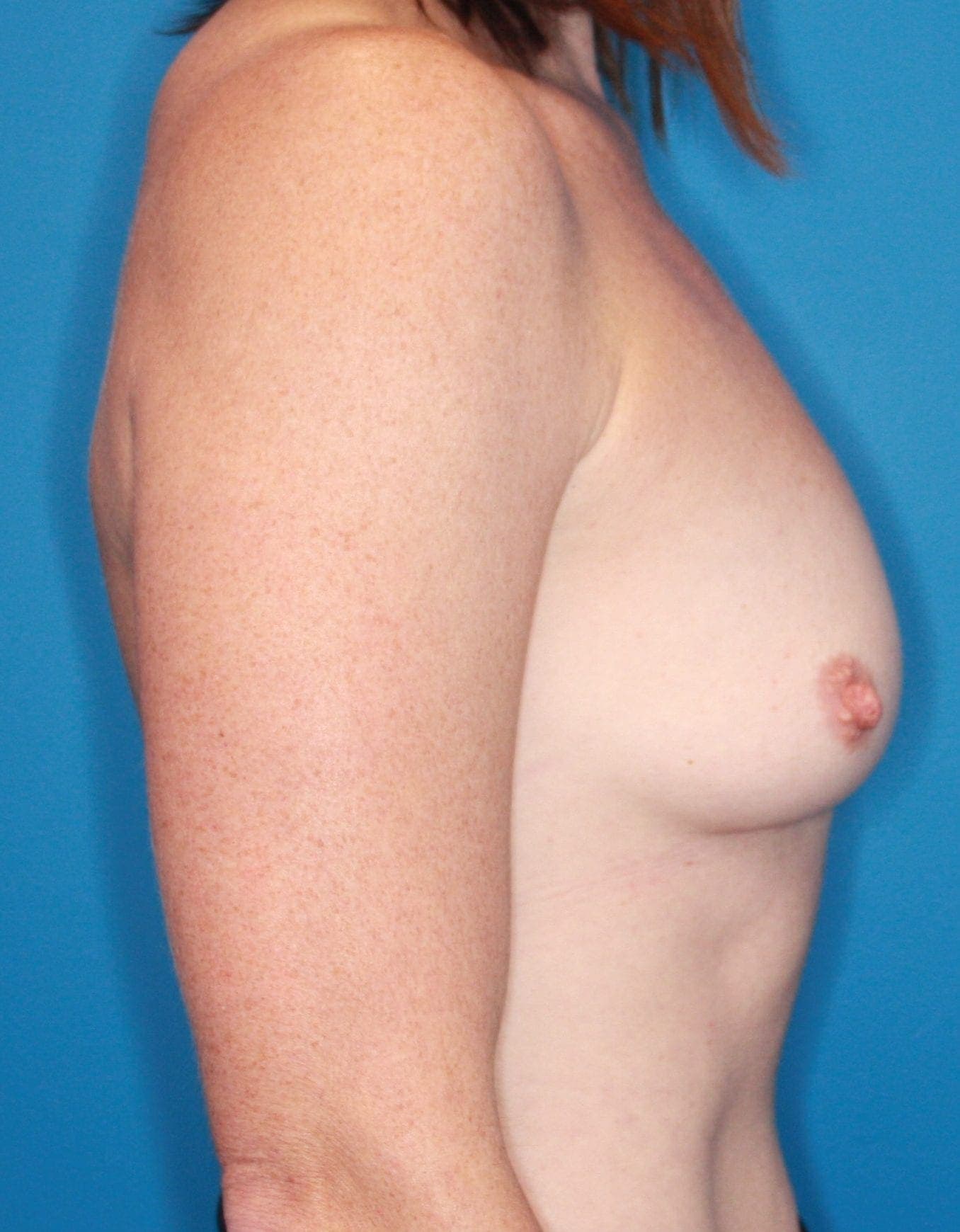 Breast case #148 before, image 4